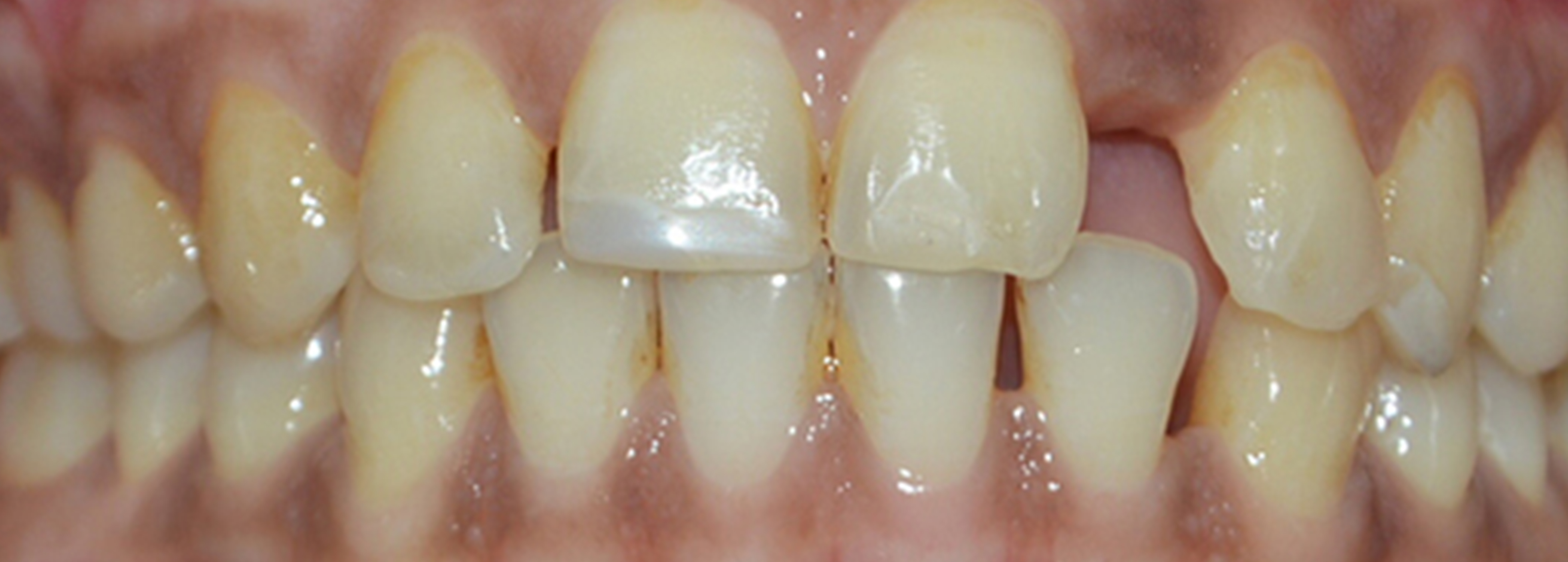 Side Gap Teeth | Before Treatment | Flash Orthodontics