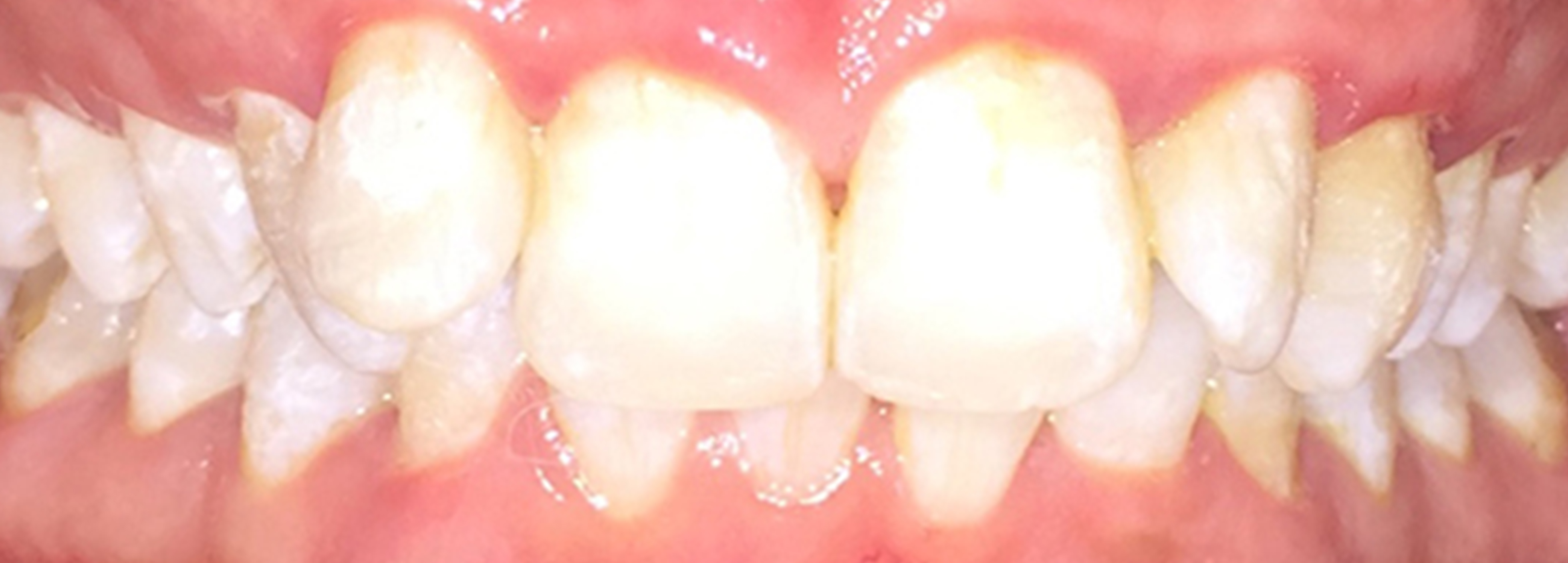 Side Gap Teeth | Before Treatment | Flash Orthodontics