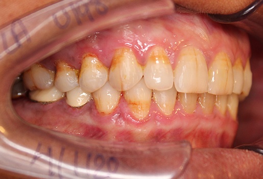 After Teeth Gap Treatment | Flash Orthodontics