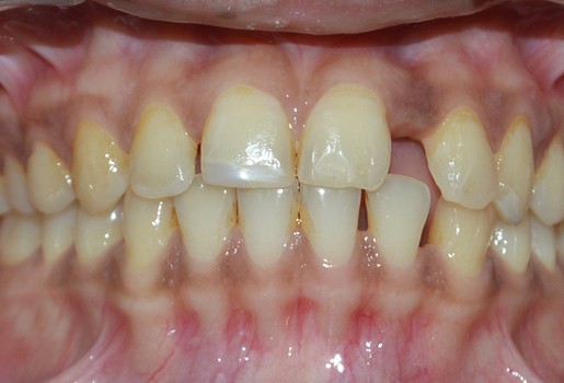 Teeth Spacing | Before Treatment | Flash Orthodontics