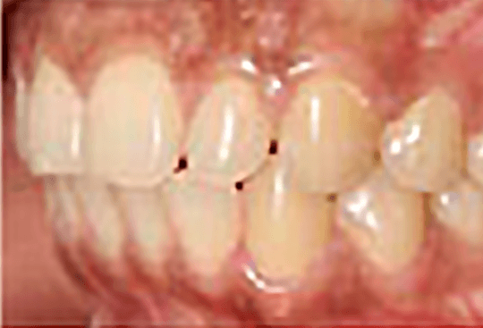After Gap between Front Teeth Treatment| Flash Orthodontics