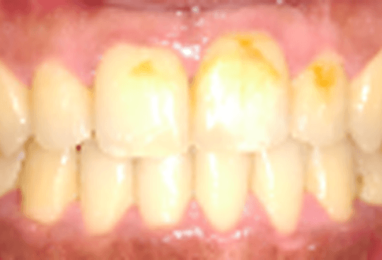 After Gap between Front Teeth Treatment| Flash Orthodontics