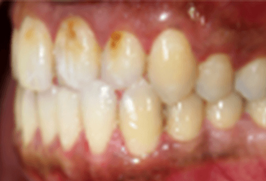 Gap in Front Teeth | Before Treatment | Flash Orthodontics