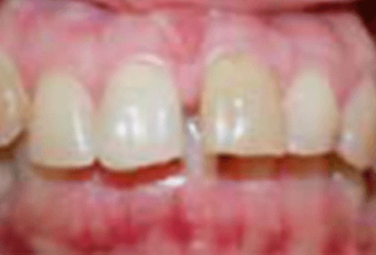 Gap in Front Teeth | Before Treatment | Flash Orthodontics