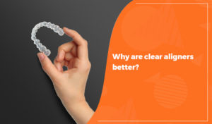 clear aligners