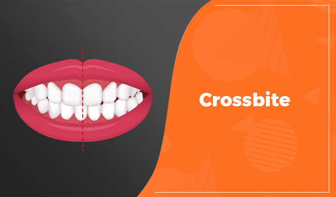 Crossbite teeth 