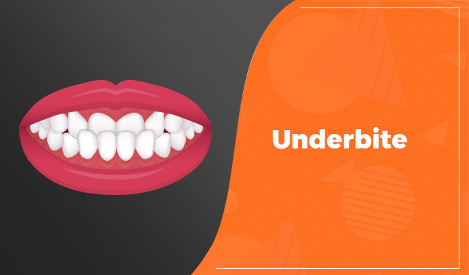 Underbite Teeth 