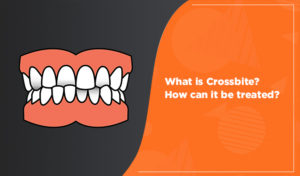 crossbite teeth