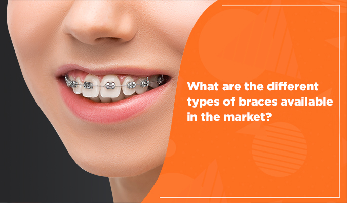 Types of braces for teeth