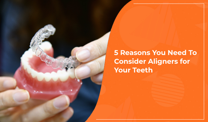 Aligners for Teeth