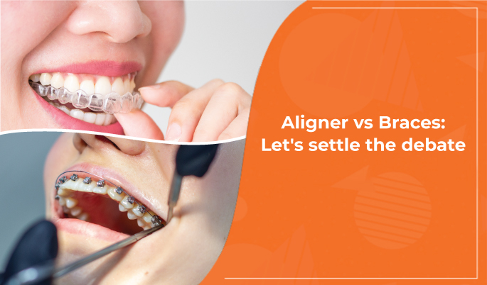 aligners vs braces