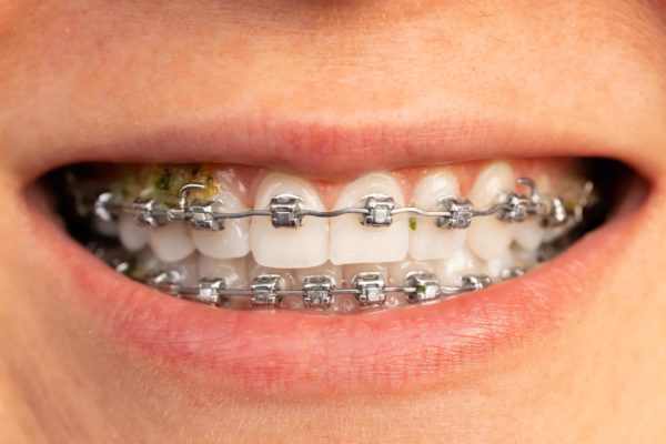 What Happens if You Eat While Wearing Braces