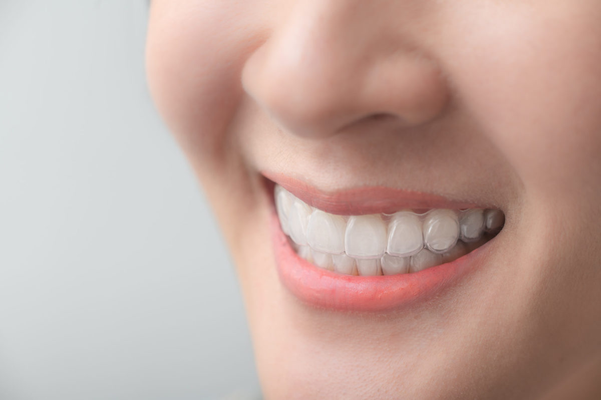 How Does 3D Scanning help in Teeth Straightening